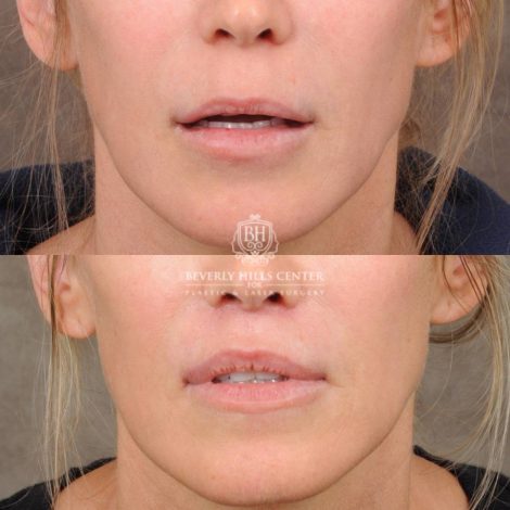 Beverly Hills Center Female Patient Before and After CUPID LIFT® Lip Lift, Profound RF