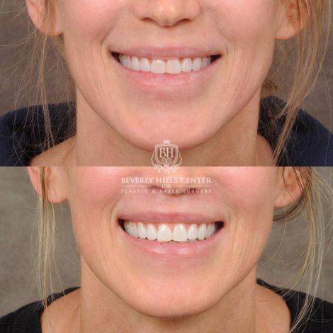 Beverly Hills Center Female Patient Before and After CUPID LIFT® Lip Lift, Profound RF