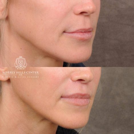 Beverly Hills Center Female Patient Before and After CUPID LIFT® Lip Lift, Profound RF