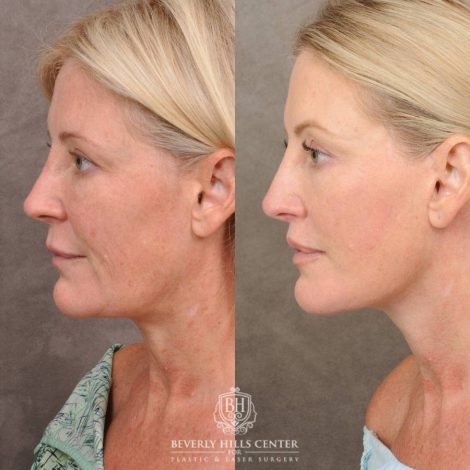 Beverly Hills Center Female Patient Before and After Auralyft, CUPID LIFT® Lip Lift, Upper Blepharoplasty, with Fat Grafting & TCA Peel