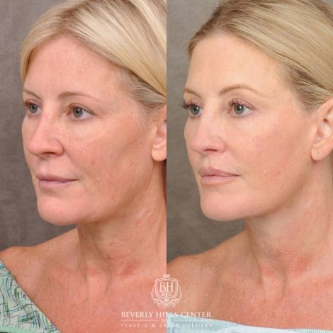 Beverly Hills Center Female Patient Before and After Auralyft, CUPID LIFT® Lip Lift, Upper Blepharoplasty, with Fat Grafting & TCA Peel