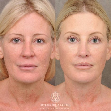 Beverly Hills Center Female Patient Before and After Auralyft, CUPID LIFT® Lip Lift, Upper Blepharoplasty, with Fat Grafting & TCA Peel
