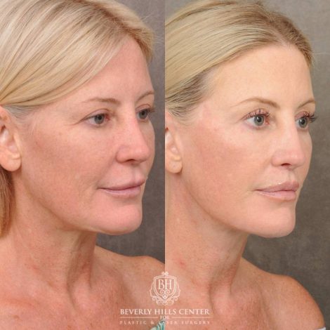 Beverly Hills Center Female Patient Before and After Auralyft, CUPID LIFT® Lip Lift, Upper Blepharoplasty, with Fat Grafting & TCA Peel