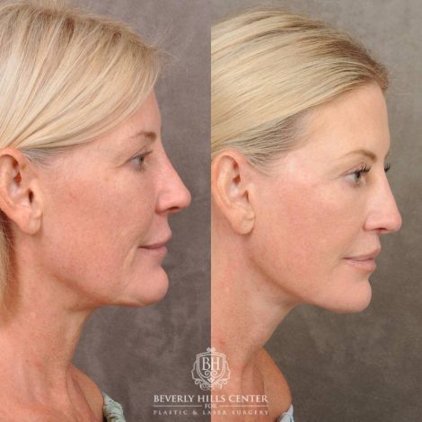 Beverly Hills Center Female Patient Before and After Auralyft, CUPID LIFT® Lip Lift, Upper Blepharoplasty, with Fat Grafting & TCA Peel