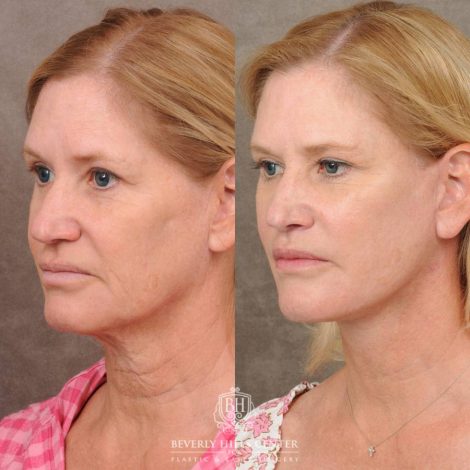 Beverly Hills Center Female Patient Before and After AuraLyft, Brow Lift, Lip Lift, Upper Blepharoplasty with Fat Grafting