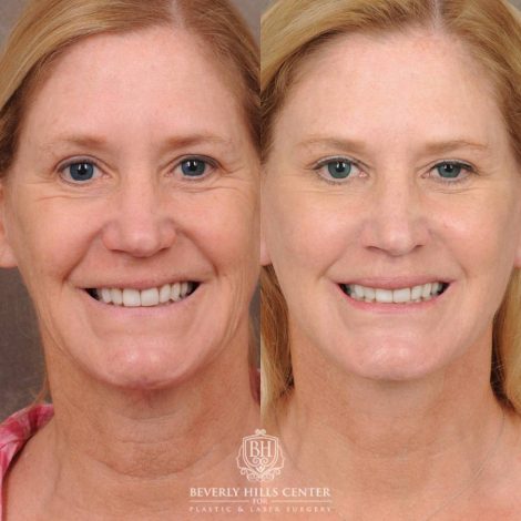 Beverly Hills Center Female Patient Before and After AuraLyft, Brow Lift, Lip Lift, Upper Blepharoplasty with Fat Grafting