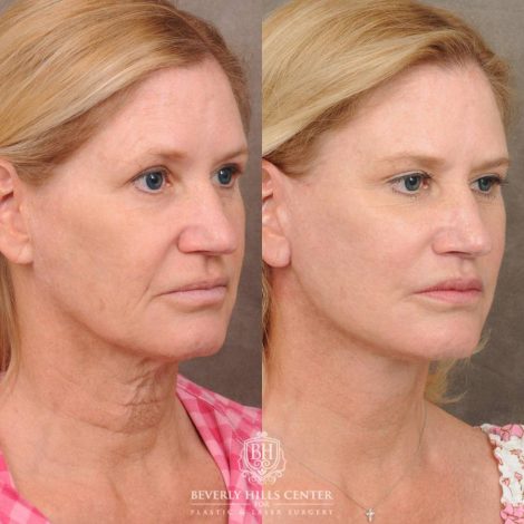 Beverly Hills Center Female Patient Before and After AuraLyft, Brow Lift, Lip Lift, Upper Blepharoplasty with Fat Grafting