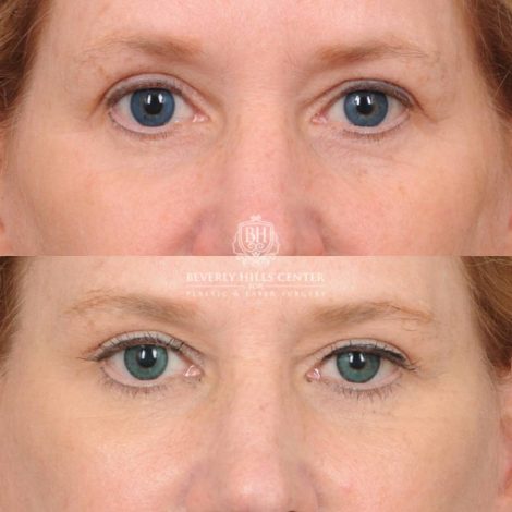 Beverly Hills Center Female Patient Before and After AuraLyft, Brow Lift, Lip Lift, Upper Blepharoplasty with Fat Grafting
