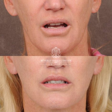 Beverly Hills Center Female Patient Before and After AuraLyft, Brow Lift, Lip Lift, Upper Blepharoplasty with Fat Grafting