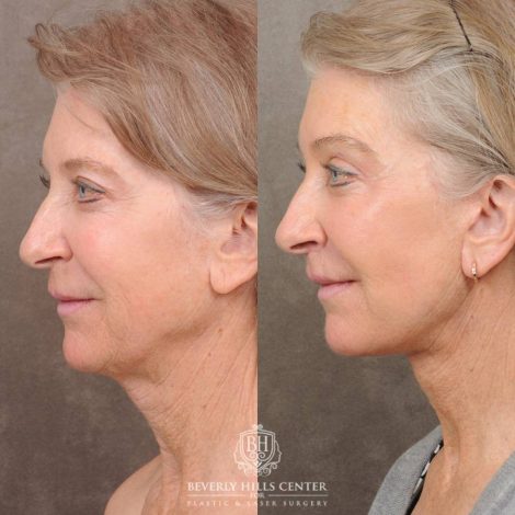 Beverly Hills Center Female Patient Before and After Auralyft, Brow Lift, CUPID LIFT® Lip Lift, Upper Blepharoplasty