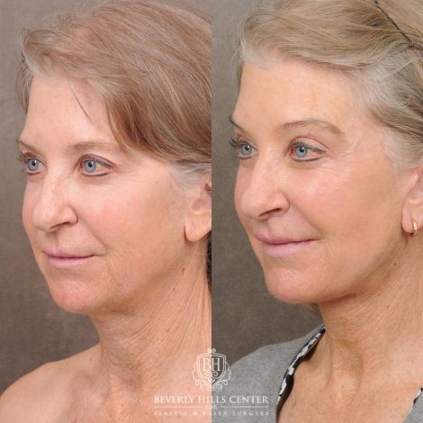 Beverly Hills Center Female Patient Before and After Auralyft, Brow Lift, CUPID LIFT® Lip Lift, Upper Blepharoplasty