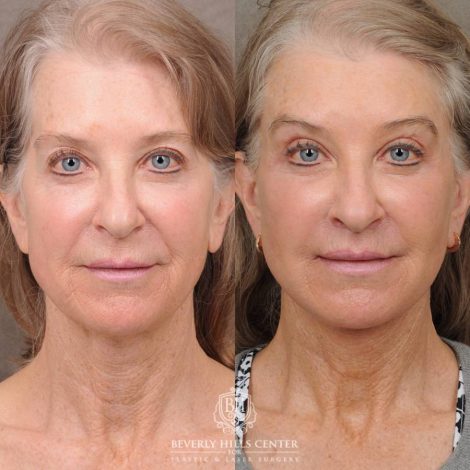 Beverly Hills Center Female Patient Before and After Auralyft, Brow Lift, CUPID LIFT® Lip Lift, Upper Blepharoplasty