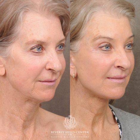 Beverly Hills Center Female Patient Before and After Auralyft, Brow Lift, CUPID LIFT® Lip Lift, Upper Blepharoplasty