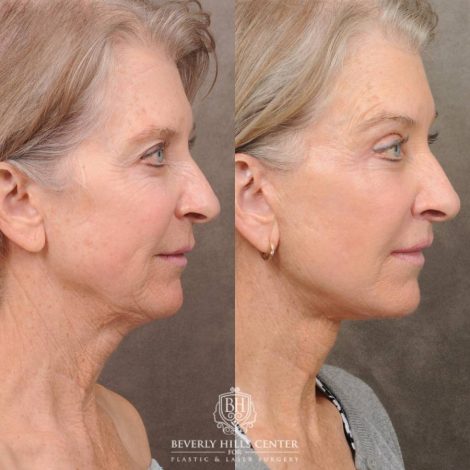 Beverly Hills Center Female Patient Before and After Auralyft, Brow Lift, CUPID LIFT® Lip Lift, Upper Blepharoplasty