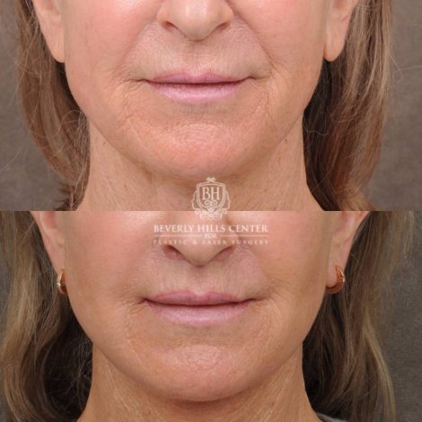 Beverly Hills Center Female Patient Before and After Auralyft, Brow Lift, CUPID LIFT® Lip Lift, Upper Blepharoplasty