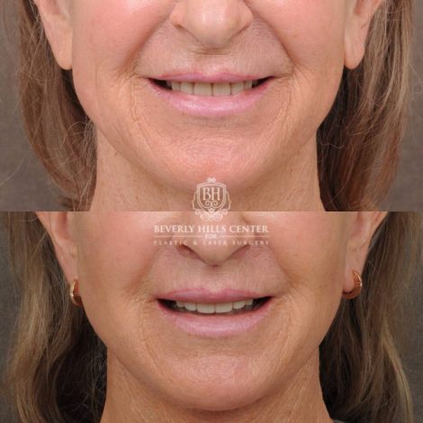 Beverly Hills Center Female Patient Before and After Auralyft, Brow Lift, CUPID LIFT® Lip Lift, Upper Blepharoplasty