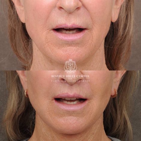 Beverly Hills Center Female Patient Before and After Auralyft, Brow Lift, CUPID LIFT® Lip Lift, Upper Blepharoplasty