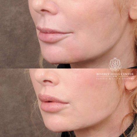 Beverly Hills Center Female Patient Before and After CUPID LIFT® Lip Lift