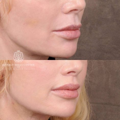 Beverly Hills Center Female Patient Before and After CUPID LIFT® Lip Lift