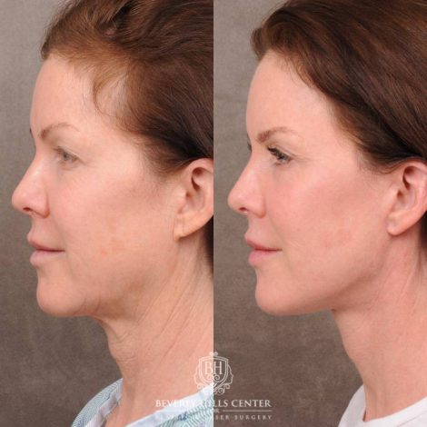 Beverly Hills Center Female Patient Before and After Auralyft, Brow Lift, Upper Blepharoplasty