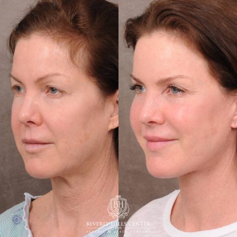 Beverly Hills Center Female Patient Before and After Auralyft, Brow Lift, Upper Blepharoplasty