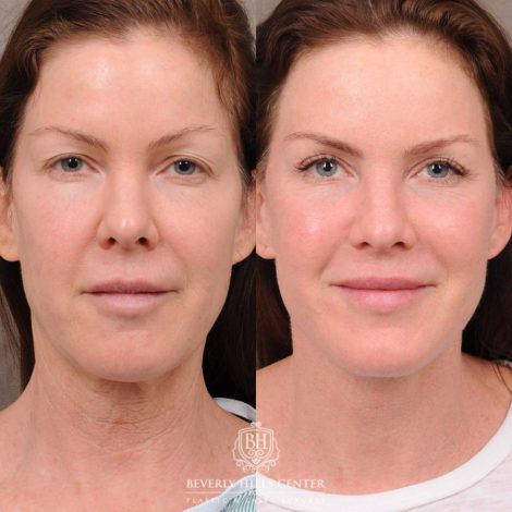 Beverly Hills Center Female Patient Before and After Auralyft, Brow Lift, Upper Blepharoplasty
