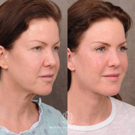 Beverly Hills Center Female Patient Before and After Auralyft, Brow Lift, Upper Blepharoplasty