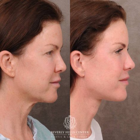 Beverly Hills Center Female Patient Before and After Auralyft, Brow Lift, Upper Blepharoplasty
