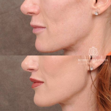 Beverly Hills Center Female Patient Before and After CUPID LIFT® Lip Lift