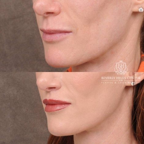 Beverly Hills Center Female Patient Before and After