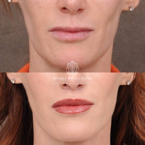Beverly Hills Center Female Patient Before and After
