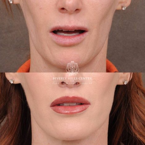 Beverly Hills Center Female Patient Before and After