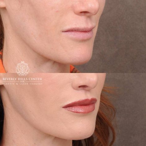 Beverly Hills Center Female Patient Before and After