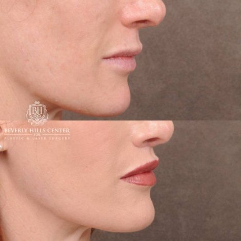 Beverly Hills Center Female Patient Before and After