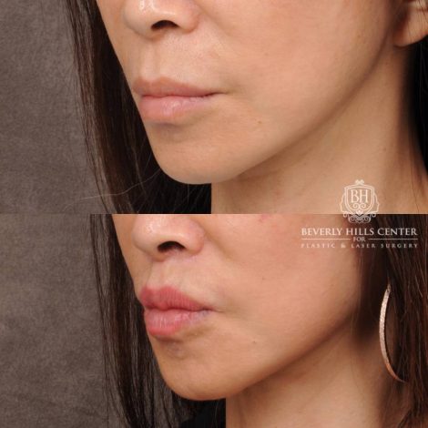 Beverly Hills Center Female Patient Before and After CUPID LIFT® Corner Lift