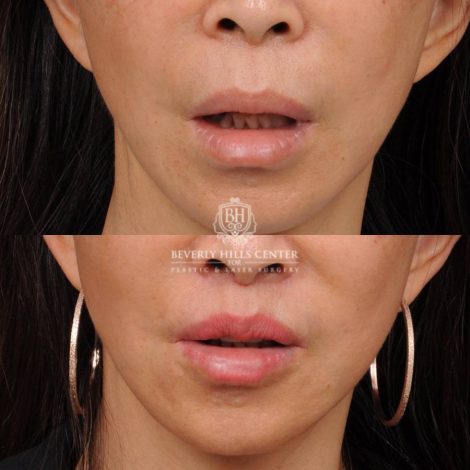 Beverly Hills Center Female Patient Before and After CUPID LIFT® Corner Lift