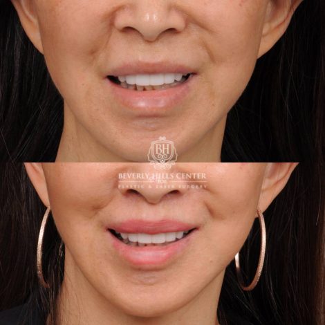 Beverly Hills Center Female Patient Before and After CUPID LIFT® Corner Lift