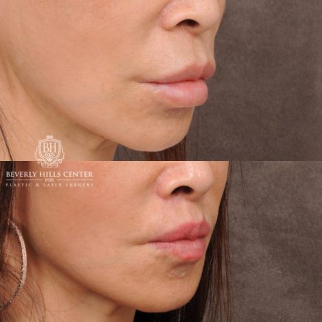 Beverly Hills Center Female Patient Before and After CUPID LIFT® Corner Lift