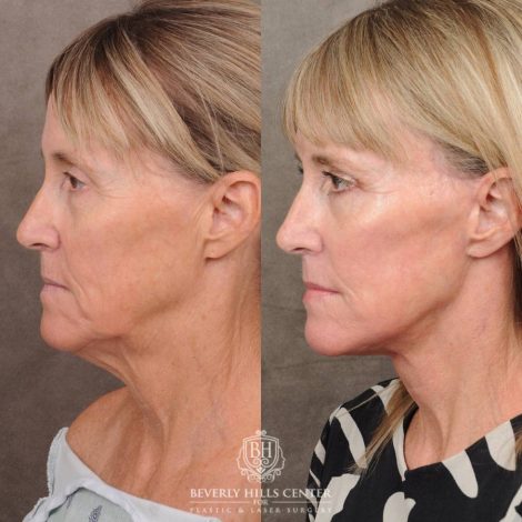 Beverly Hills Center Female Patient Before and After AuraLyft, Brow Lift, Upper Blepharoplasty, CUPID LIFT® Corner Lift with TCA Peel