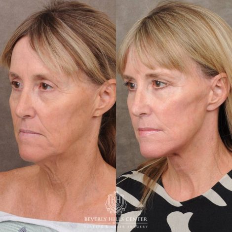 Beverly Hills Center Female Patient Before and After AuraLyft, Brow Lift, Upper Blepharoplasty, CUPID LIFT® Corner Lift with TCA Peel