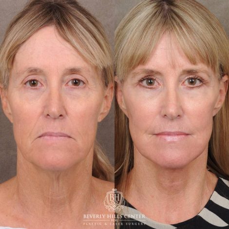 Beverly Hills Center Female Patient Before and After AuraLyft, Brow Lift, Upper Blepharoplasty, CUPID LIFT® Corner Lift with TCA Peel