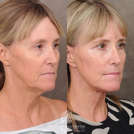 Beverly Hills Center Female Patient Before and After AuraLyft, Brow Lift, Upper Blepharoplasty, CUPID LIFT® Corner Lift with TCA Peel