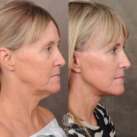 Beverly Hills Center Female Patient Before and After AuraLyft, Brow Lift, Upper Blepharoplasty, CUPID LIFT® Corner Lift with TCA Peel
