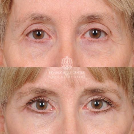 Beverly Hills Center Female Patient Before and After AuraLyft, Brow Lift, Upper Blepharoplasty, CUPID LIFT® Corner Lift with TCA Peel