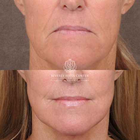 Beverly Hills Center Female Patient Before and After AuraLyft, Brow Lift, Upper Blepharoplasty, CUPID LIFT® Corner Lift with TCA Peel