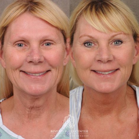 Beverly Hills Center Female Patient Before and After AuraLyft, CUPID LIFT® Lip Lift, Upper Blepharoplasty