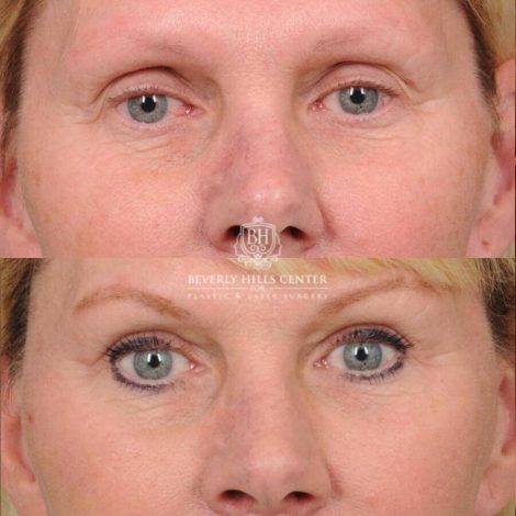Beverly Hills Center Female Patient Before and After Upper Blepharoplasty