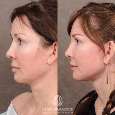 Beverly Hills Center Female Patient Before and After CUPID LIFT® Lip Lift