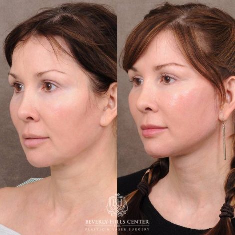 Beverly Hills Center Female Patient Before and After CUPID LIFT® Lip Lift