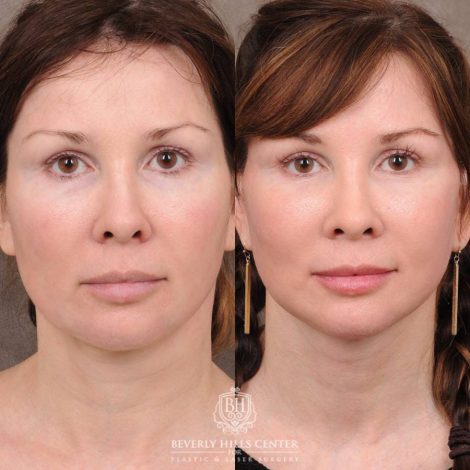 Beverly Hills Center Female Patient Before and After CUPID LIFT® Lip Lift